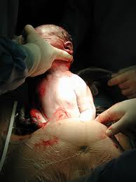 cesarea nacimiento bebe