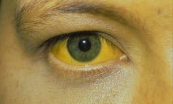 hepatitis SSM