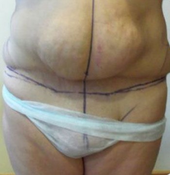 Mujer adelgaza 60 kilos y le sale un pene en la entrepierna