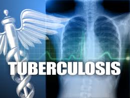 tuberculosis