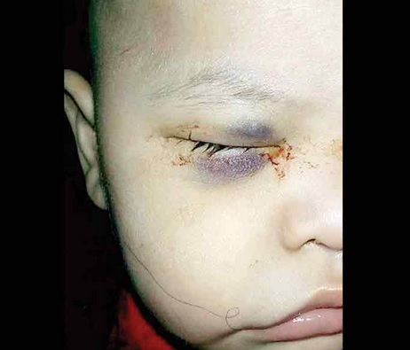 imss niño operado ojo