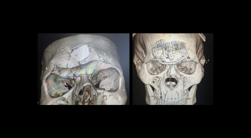 Evangelista Santos-peleador de MMA