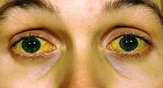 ojos amarillos hepatitis