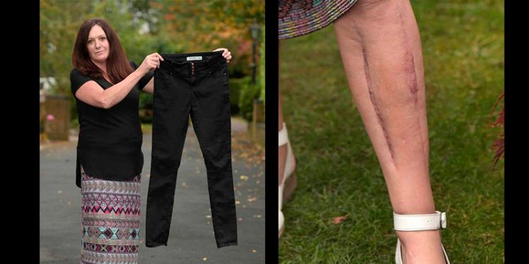 casi-pierde-la-pierna-por-utlizar-jeans-ajustados